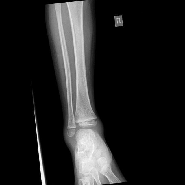 Original X-ray — Oblique Displaced fracture