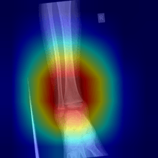 Grad-CAM heatmap — Oblique Displaced fracture — DenseNet-169