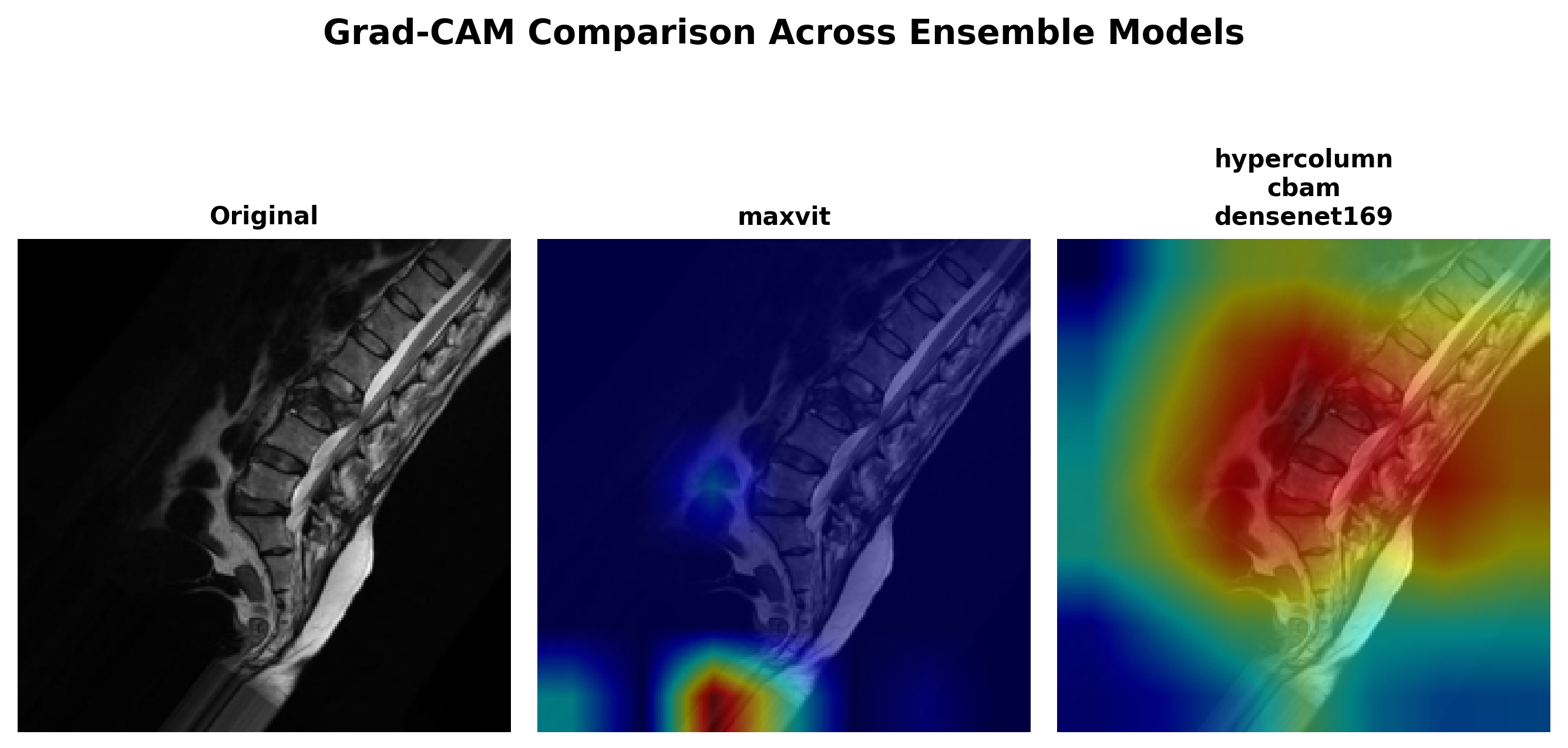 Grad-CAM heatmaps comparison for Comminuted fracture